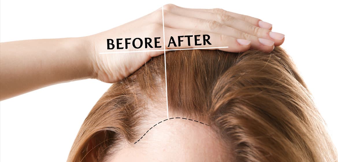 Hair Loss Treatment