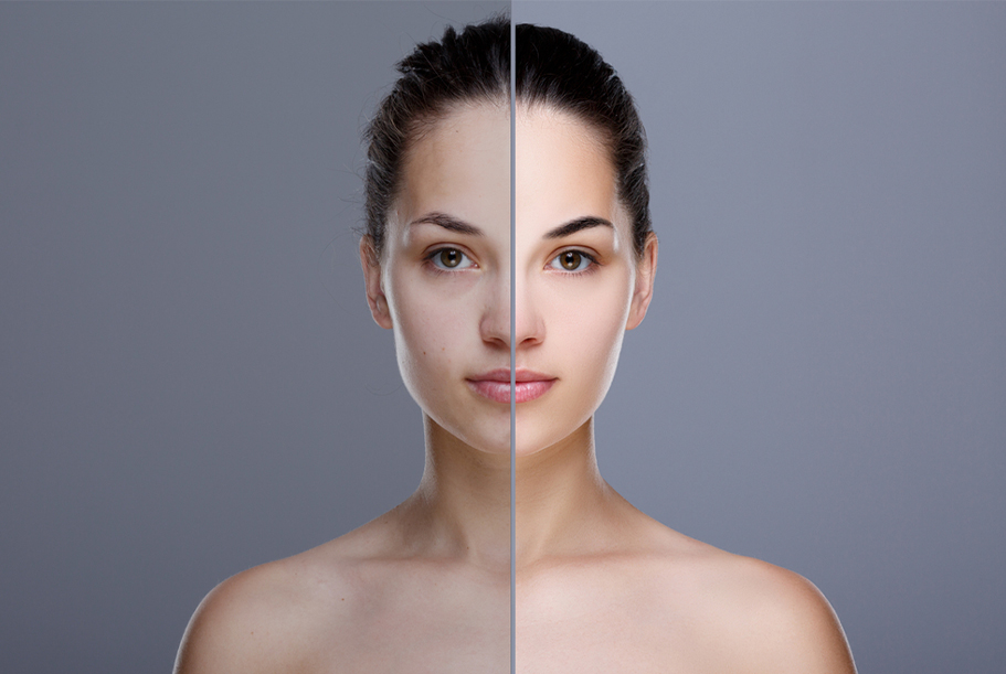 Skin Pigmentation Treatment